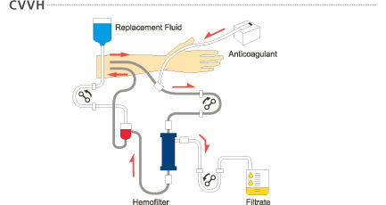 持续徐缓式血液滤过(CVVH: continuous veno-venous hemofiltration)