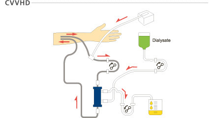 持续徐缓式血液透析(CVVHD: continuous veno-venous hemodialysis)