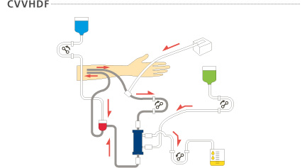 持续徐缓式血液滤过透析(CVVHDF: continuous veno-venous hemodiafiltration)