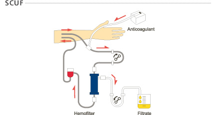 SCUF(Slow Continuous UltraFiltration)