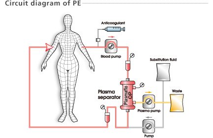 单膜血浆置换疗法