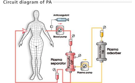 血浆吸附疗法